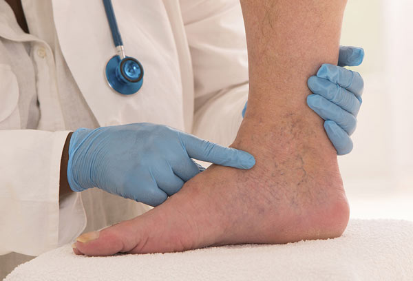 doctor examining varicose veins in a patient's ankle