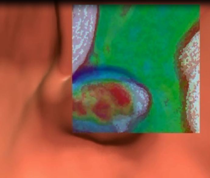 colon with a virtual screen over it