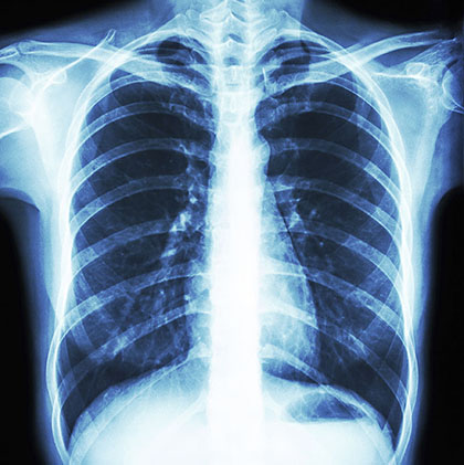 Chest x-ray